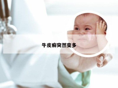 牛皮癣突然变多