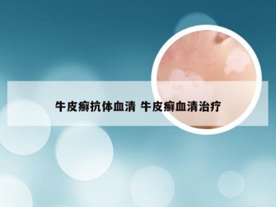 牛皮癣抗体血清 牛皮癣血清治疗