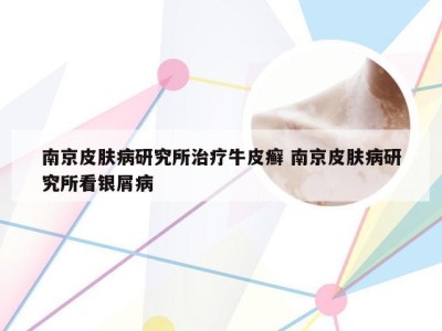 南京皮肤病研究所治疗牛皮癣 南京皮肤病研究所看银屑病