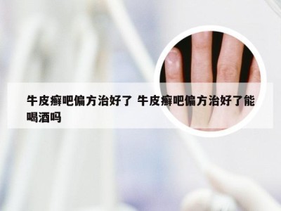 牛皮癣吧偏方治好了 牛皮癣吧偏方治好了能喝酒吗