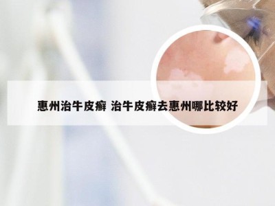 惠州治牛皮癣 治牛皮癣去惠州哪比较好