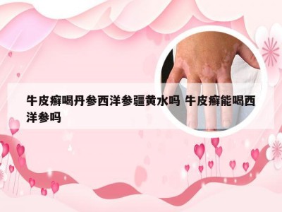 牛皮癣喝丹参西洋参疆黄水吗 牛皮癣能喝西洋参吗