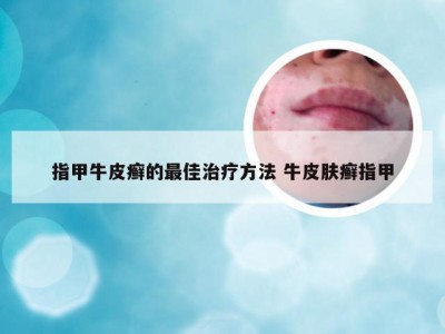 指甲牛皮癣的最佳治疗方法 牛皮肤癣指甲