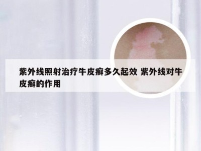 紫外线照射治疗牛皮癣多久起效 紫外线对牛皮癣的作用