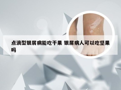 点滴型银屑病能吃干果 银屑病人可以吃坚果吗