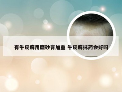 有牛皮癣用磨砂膏加重 牛皮癣抹药会好吗