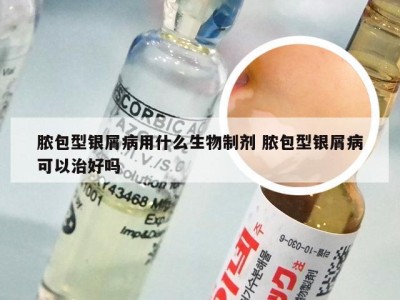 脓包型银屑病用什么生物制剂 脓包型银屑病可以治好吗