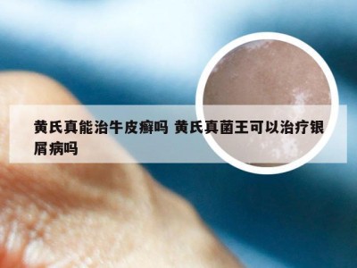 黄氏真能治牛皮癣吗 黄氏真菌王可以治疗银屑病吗