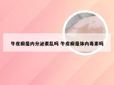 牛皮癣是内分泌紊乱吗 牛皮癣是体内毒素吗