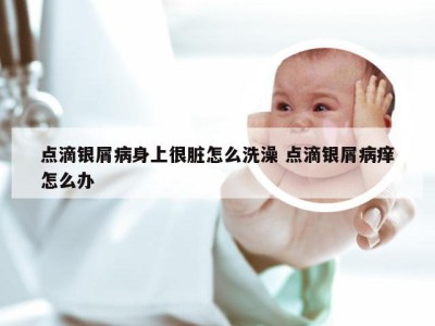 点滴银屑病身上很脏怎么洗澡 点滴银屑病痒怎么办