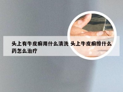头上有牛皮癣用什么清洗 头上牛皮癣擦什么药怎么治疗