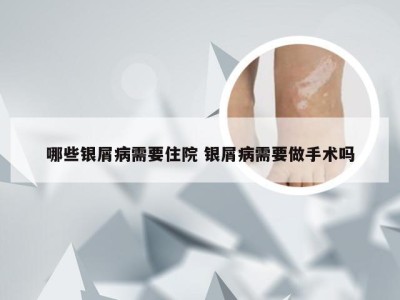 哪些银屑病需要住院 银屑病需要做手术吗
