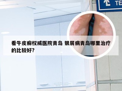 看牛皮癣权威医院青岛 银屑病青岛哪里治疗的比较好?