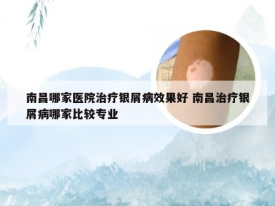 南昌哪家医院治疗银屑病效果好 南昌治疗银屑病哪家比较专业