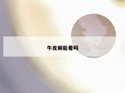 牛皮癣能看吗