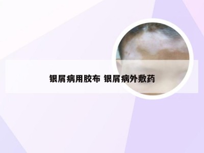 银屑病用胶布 银屑病外敷药