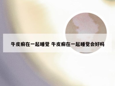 牛皮癣在一起睡觉 牛皮癣在一起睡觉会好吗