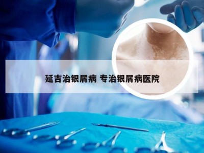 延吉治银屑病 专治银屑病医院