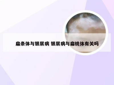 扁条体与银屑病 银屑病与扁桃体有关吗