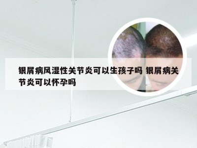 银屑病风湿性关节炎可以生孩子吗 银屑病关节炎可以怀孕吗
