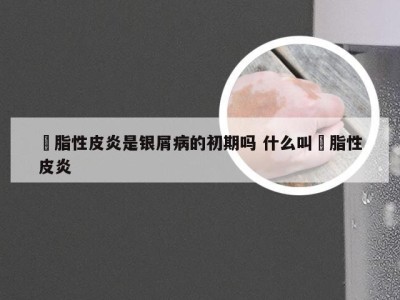 膉脂性皮炎是银屑病的初期吗 什么叫膉脂性皮炎