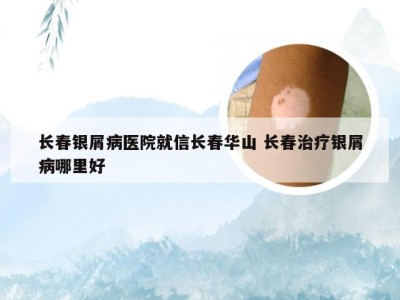 长春银屑病医院就信长春华山 长春治疗银屑病哪里好