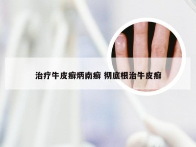 治疗牛皮癣炳南癣 彻底根治牛皮癣