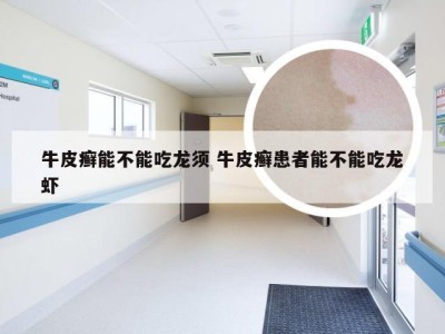 牛皮癣能不能吃龙须 牛皮癣患者能不能吃龙虾