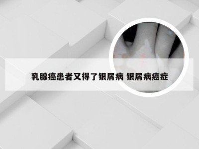 乳腺癌患者又得了银屑病 银屑病癌症