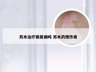 苏木治疗银屑病吗 苏木药理作用