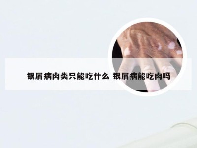 银屑病肉类只能吃什么 银屑病能吃肉吗