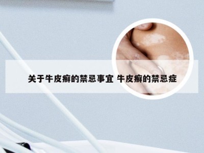 关于牛皮癣的禁忌事宜 牛皮癣的禁忌症