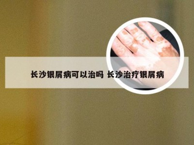 长沙银屑病可以治吗 长沙治疗银屑病