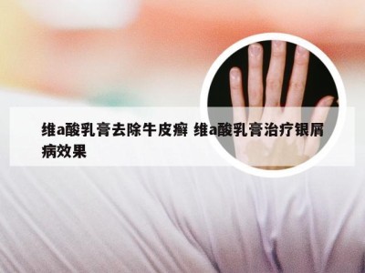 维a酸乳膏去除牛皮癣 维a酸乳膏治疗银屑病效果