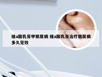 维a酸乳膏甲银屑病 维a酸乳膏治疗银屑病多久见效