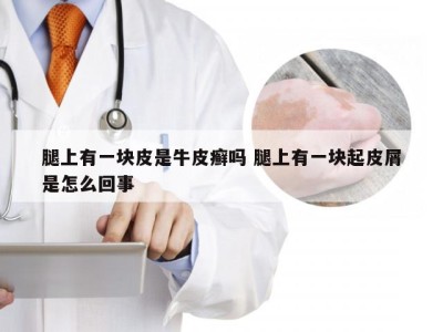 腿上有一块皮是牛皮癣吗 腿上有一块起皮屑是怎么回事