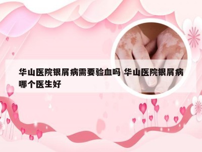 华山医院银屑病需要验血吗 华山医院银屑病哪个医生好