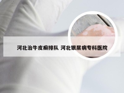 河北治牛皮癣排队 河北银屑病专科医院