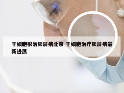 干细胞根治银屑病北京 干细胞治疗银屑病最新进展