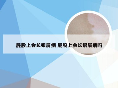 屁股上会长银屑病 屁股上会长银屑病吗