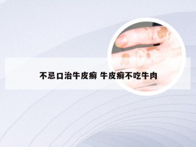 不忌口治牛皮癣 牛皮癣不吃牛肉