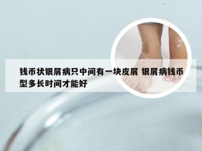 钱币状银屑病只中间有一块皮屑 银屑病钱币型多长时间才能好