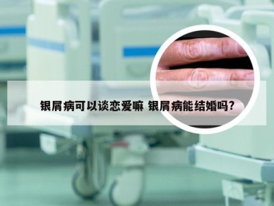 银屑病可以谈恋爱嘛 银屑病能结婚吗?