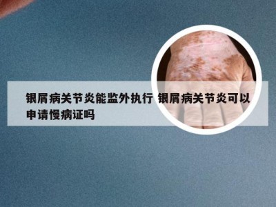 银屑病关节炎能监外执行 银屑病关节炎可以申请慢病证吗