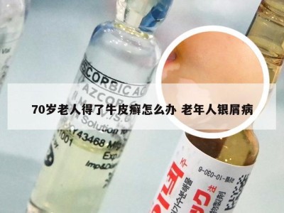70岁老人得了牛皮癣怎么办 老年人银屑病