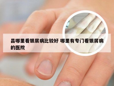 昌哪里看银屑病比较好 哪里有专门看银屑病的医院