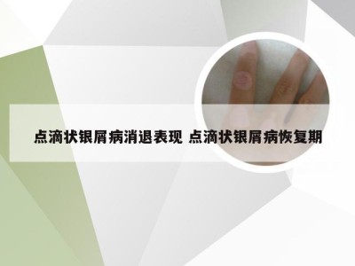 点滴状银屑病消退表现 点滴状银屑病恢复期
