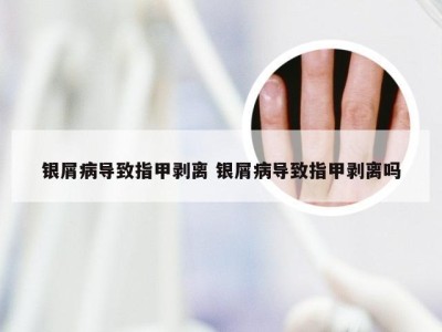 银屑病导致指甲剥离 银屑病导致指甲剥离吗