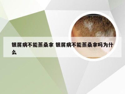 银屑病不能蒸桑拿 银屑病不能蒸桑拿吗为什么