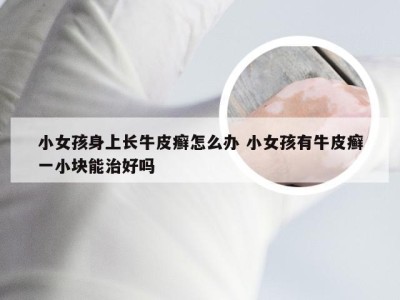 小女孩身上长牛皮癣怎么办 小女孩有牛皮癣一小块能治好吗